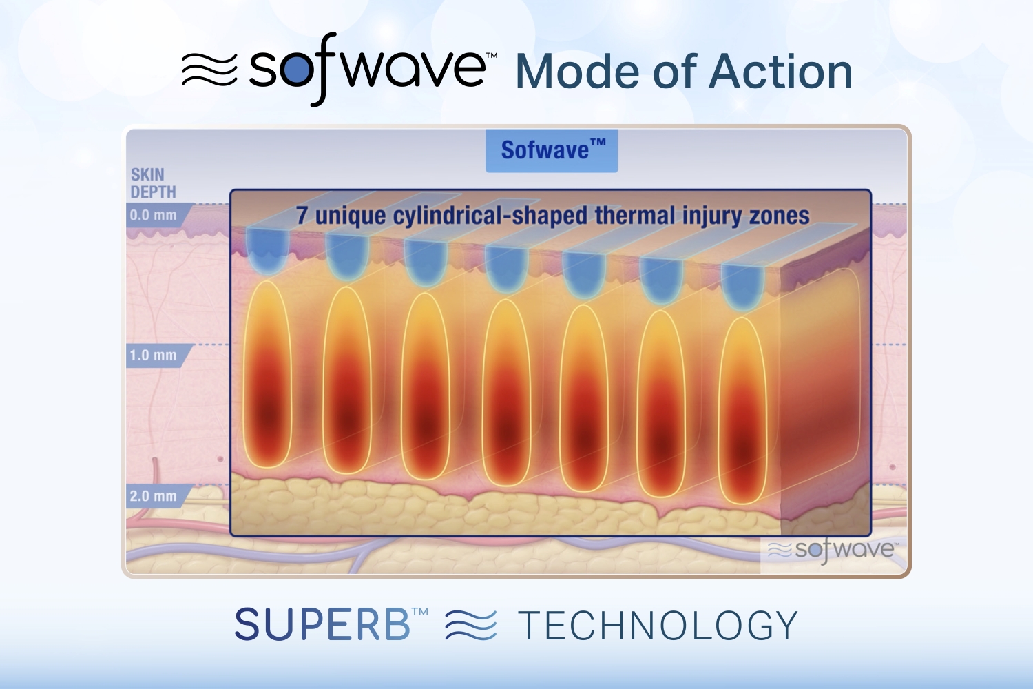 Sofwave